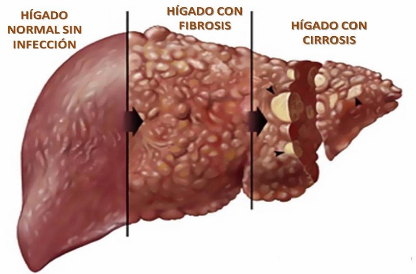 Sintomas de Cirrosis hepática